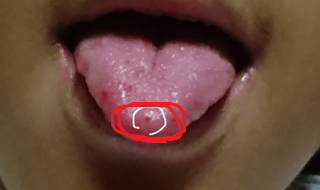 舌に関する質問です 今現在私の舌先にほんの小さい黒い点みたい Yahoo 知恵袋