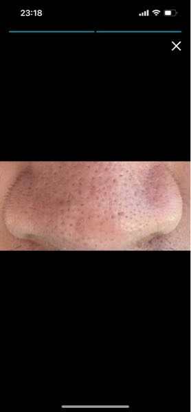 Nikki's Skin Clear　通常版 ニッキーズスキンクリア Nikki's Skin Clear 通常使用 (シミ