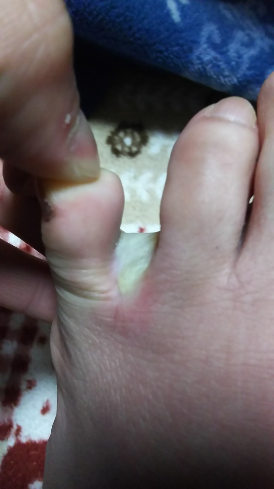 足の指の間に大きな水ぶくれができて痛いです 薬指と小指の間が痛 Yahoo 知恵袋