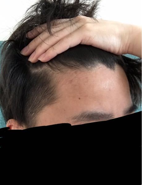 M字ハゲはほぼ100 Agaでしょうか 個人輸入でフィン Yahoo 知恵袋