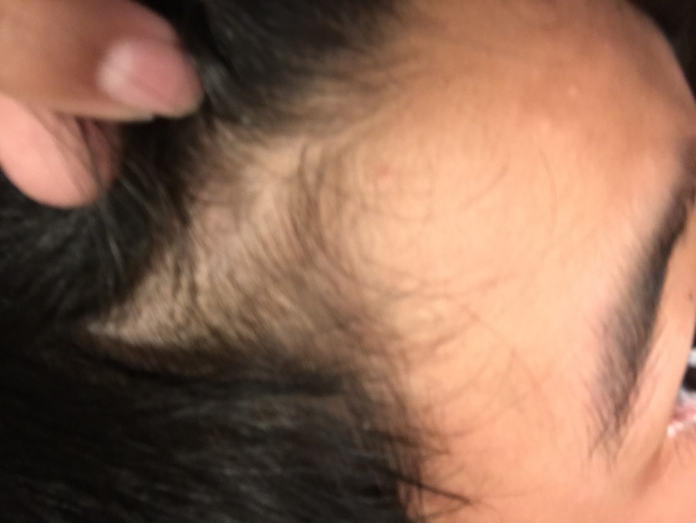 中学生男子です ここ半年ぼどでものすごく抜け毛が多くなってきて少し薄毛に Yahoo 知恵袋