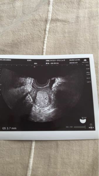 妊娠5週と3日で胎嚢3 7mmは小さすぎますよね 病院ではまた1週間後に Yahoo 知恵袋