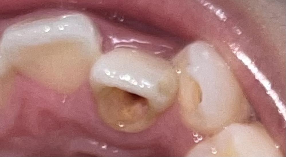 根管治療中で 膿の出口を作るため 2本の歯の裏側に穴を開けてあ Yahoo 知恵袋