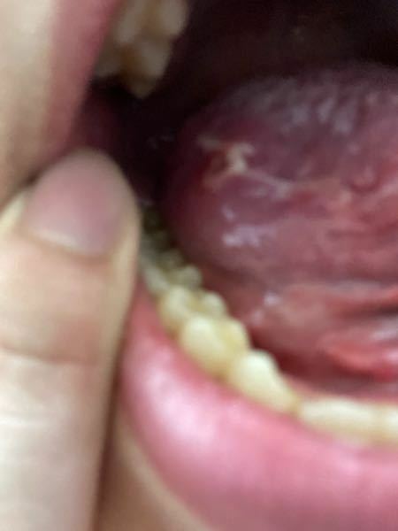 舌の側面に白い筋のようなものがありすごく痛みます 調べると舌癌 Yahoo 知恵袋