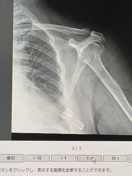上腕骨近位端骨折と診断されましたが 救急車で運ばれた時のレントゲンを知り Yahoo 知恵袋