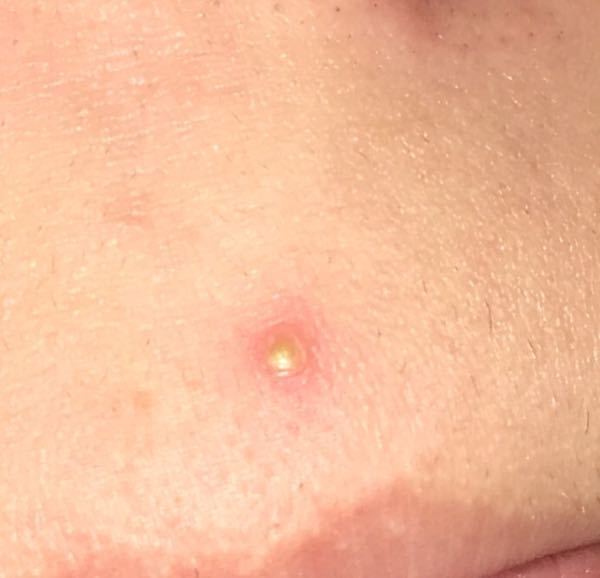 ニキビの膿が溜まってたので 針で突いて破りました 指で押 Yahoo 知恵袋