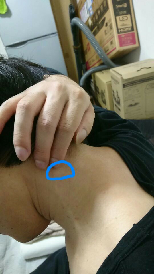 首のしこりが出来た人に質問です 首のしこりが出来た時に首が Yahoo 知恵袋