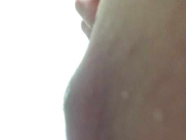 以前 初めて毛嚢炎のようなvラインに出来 お月様だったけど 婦人科で診ても Yahoo 知恵袋