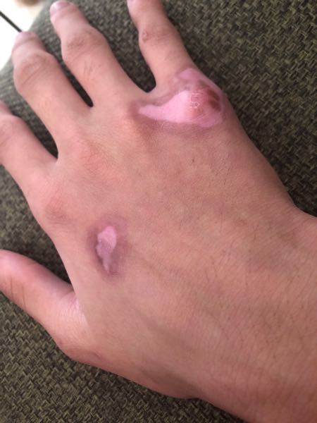 ドライアイスの火傷 火傷 についてですが ２ ３ヶ月ぐらい前 高校の Yahoo 知恵袋