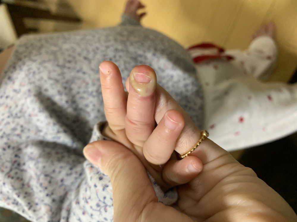１歳の娘が指しゃぶりをする為昨日小児科でひょう疽と診断されました 抗生物質 Yahoo 知恵袋