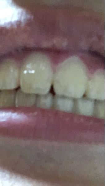 今日からリテーナーを付けないといけないのですが 食事後学校で歯磨きしないと Yahoo 知恵袋