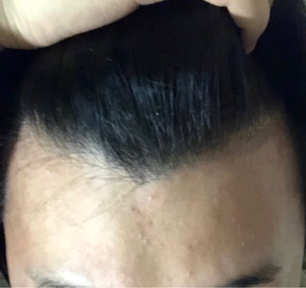 生まれつき剃り込みは入っていたんですけど少し不安になっています これ Yahoo 知恵袋