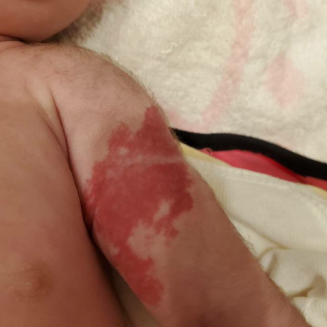生後2週間の乳児なのですが5日程前から腕に赤いあざのような湿疹ができたので Yahoo 知恵袋