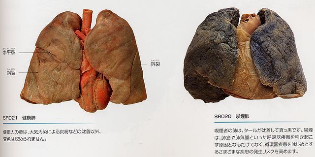 喫煙者が禁煙をすると黒くなった肺が元に戻るというのを見ました 正直疑 Yahoo 知恵袋