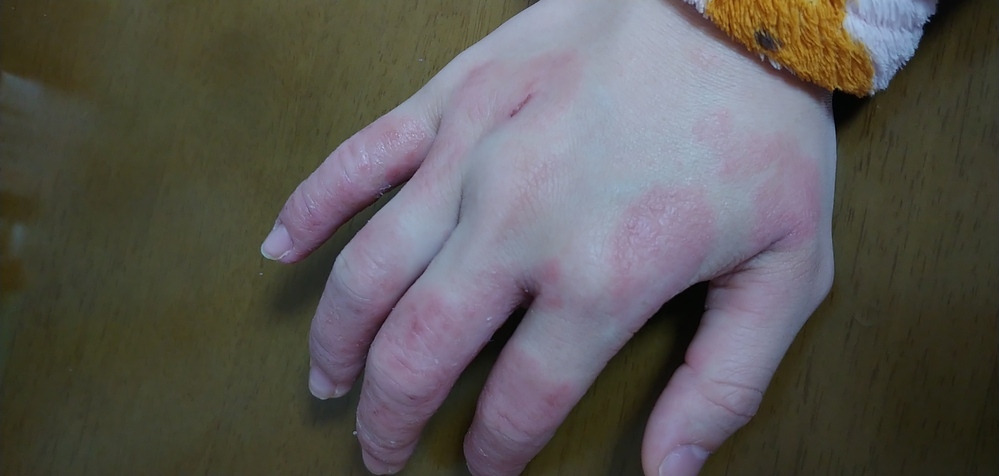 手荒れが酷くて皮膚科でデルモベートやジフラールを出してもらったのに良くなり Yahoo 知恵袋