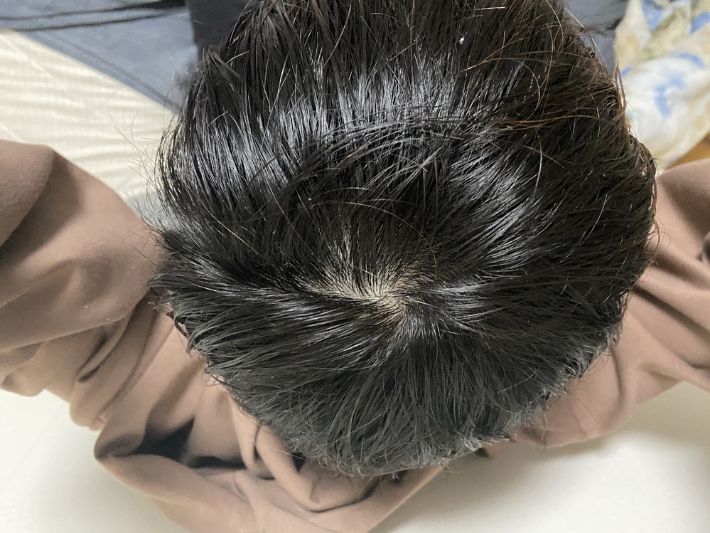 つむじ禿げってどこからがですか Yahoo 知恵袋