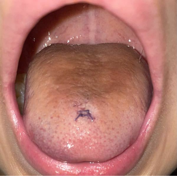 舌 黒毛 黒毛舌をご存知ですか？ 予防と治療法