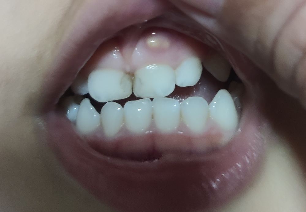最速 子供 歯茎 フィステル 治療