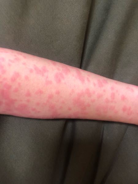 薬疹は皮膚科に行けばわかりますか 血液検査などしないといけないのでしょ Yahoo 知恵袋