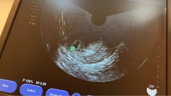 胎嚢の形について 現在推定5w1dです 先程胎嚢確認のためにエ Yahoo 知恵袋