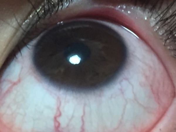 これはただの充血ですか それとも角膜血管新生ですか 眼科医です 角膜が Yahoo 知恵袋