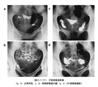 橋本病の方で 卵管造影検査 水性 をされた方にお聞きします 検査後 血液検査 Yahoo 知恵袋