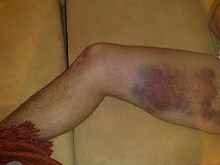 こむらがえりが起きた時 起きた場所の筋肉の超回復は期待できますか Yahoo 知恵袋