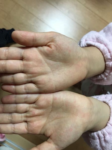 両手ますかけ線て極端な手相だと言いますが 本当なのでしょうか Yahoo 知恵袋