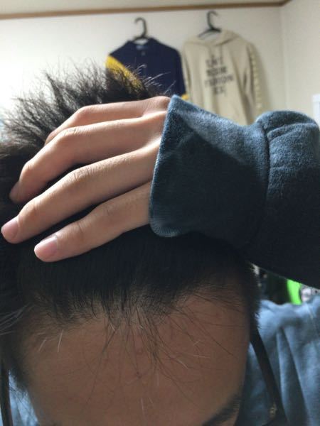 抜け毛がひどいです 高3の男です もともと髪の毛が細いのですが Yahoo 知恵袋