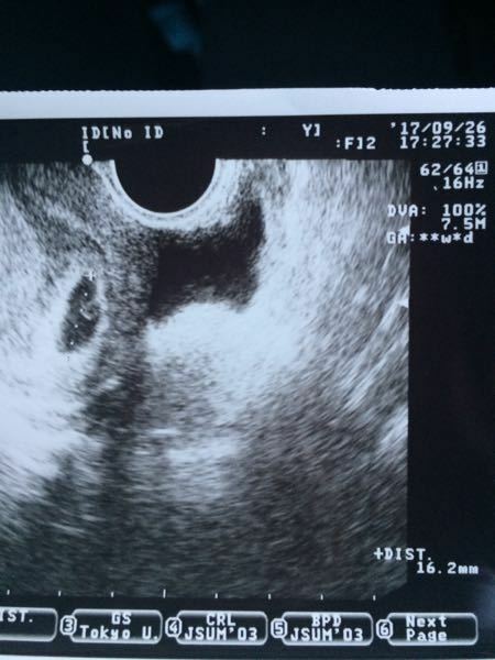 妊娠初期 出血 レバー 塊