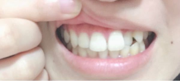思いっきり笑うと頬骨がすごい出るのですが これは頬骨ですか それともほっぺの肉 Yahoo 知恵袋