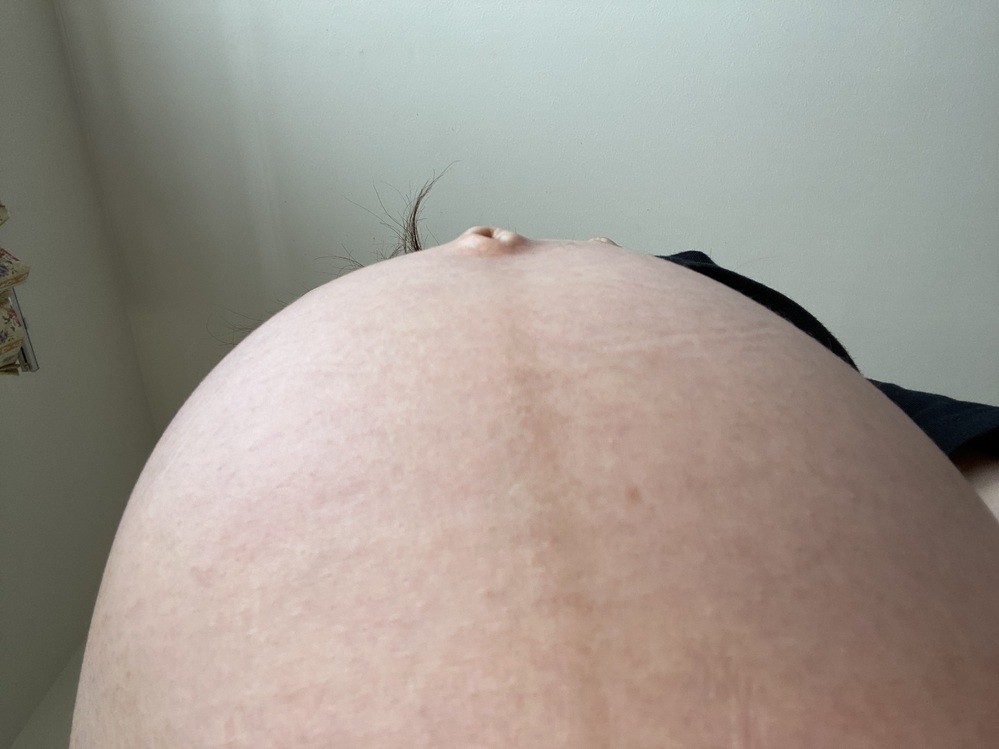 この画像は妊娠線もうありますか 正中線は違うとわかりますが なんというか皮膚の Yahoo 知恵袋