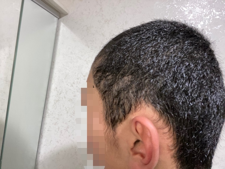 高校1年生です。今坊主で髪の毛を伸ばしたいと思っているのですが