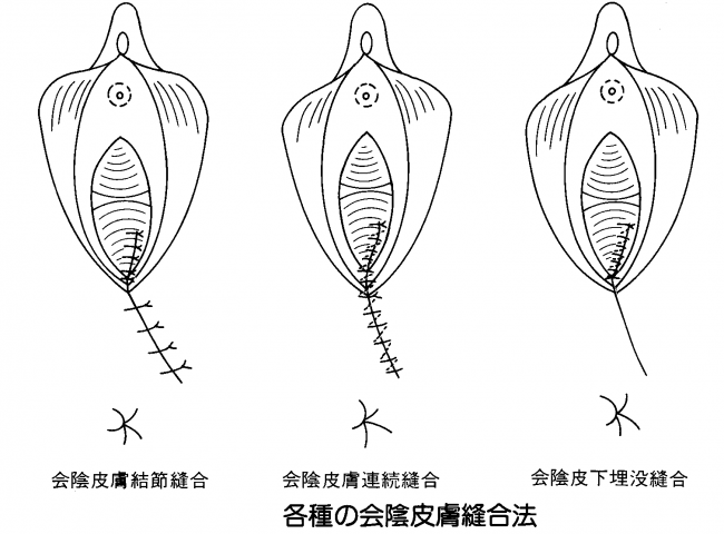 会陰切開されてる時ってどんな感じでしたか ジョキジョキ という感じなのか一瞬チ Yahoo 知恵袋